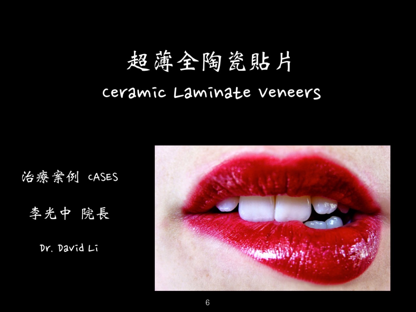 超薄全陶瓷貼片案例案例圖