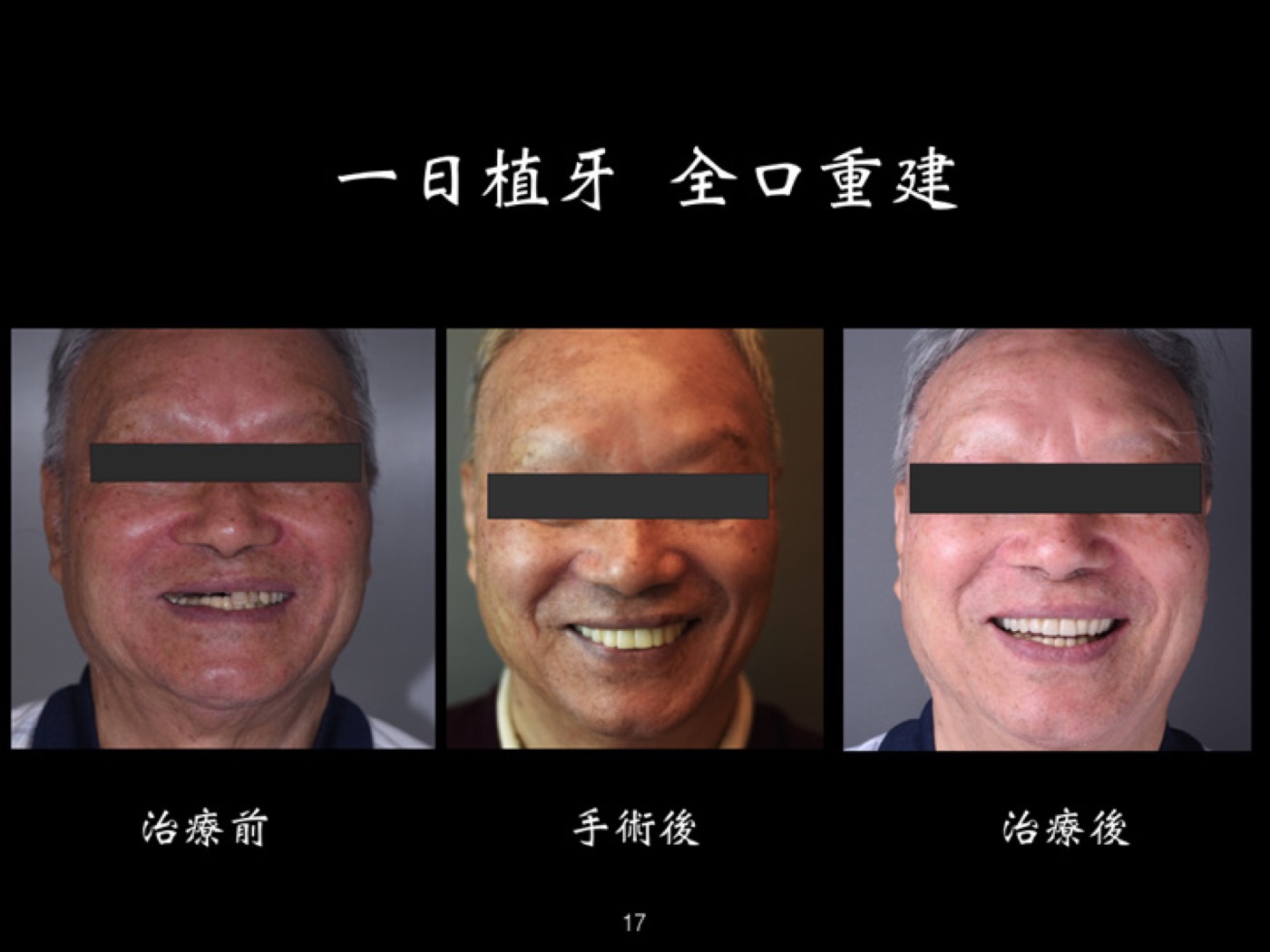 一日植牙全口重建案例圖例 5