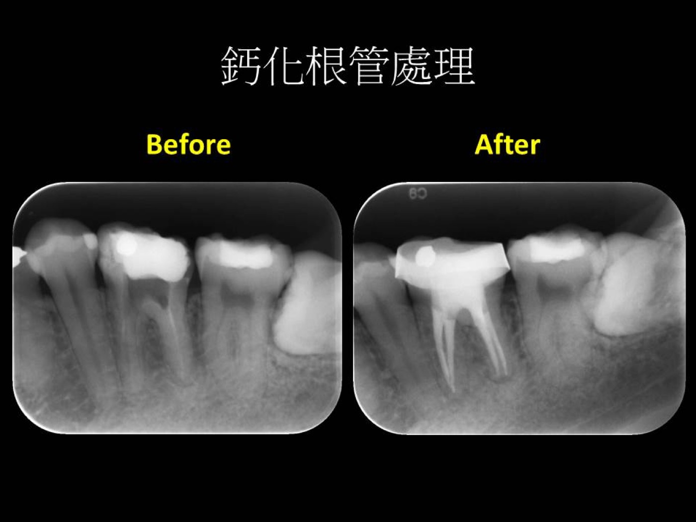 根管治療案例案例圖