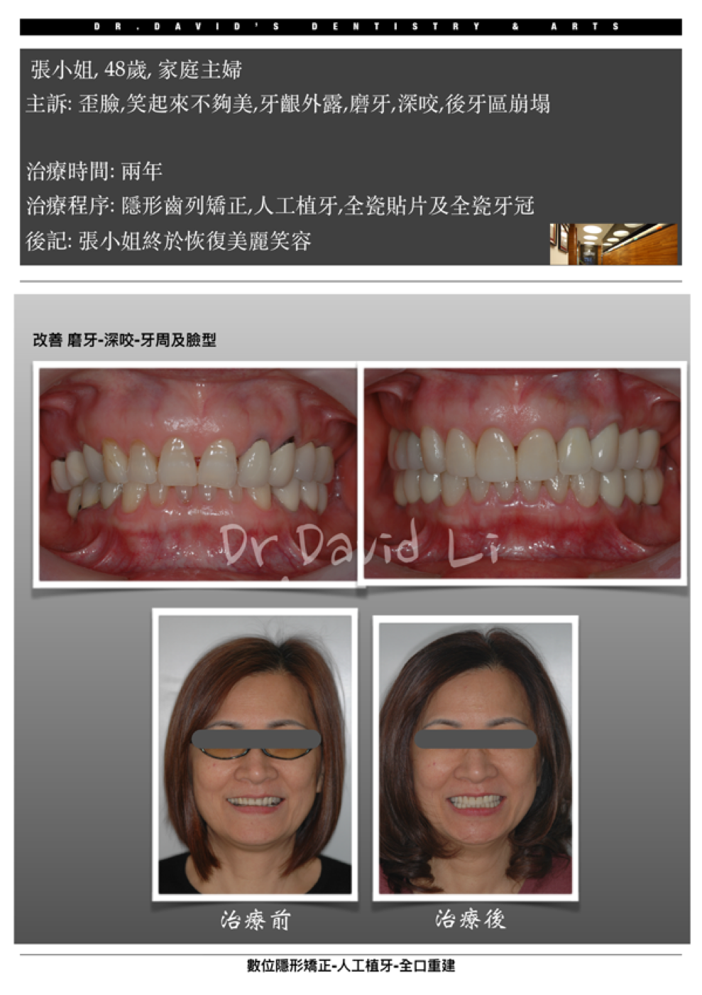 微笑塑型與全口重建案例圖例 3